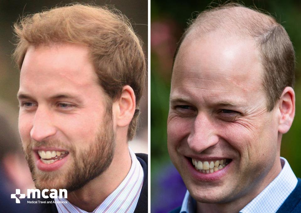 Prince Williams Before After