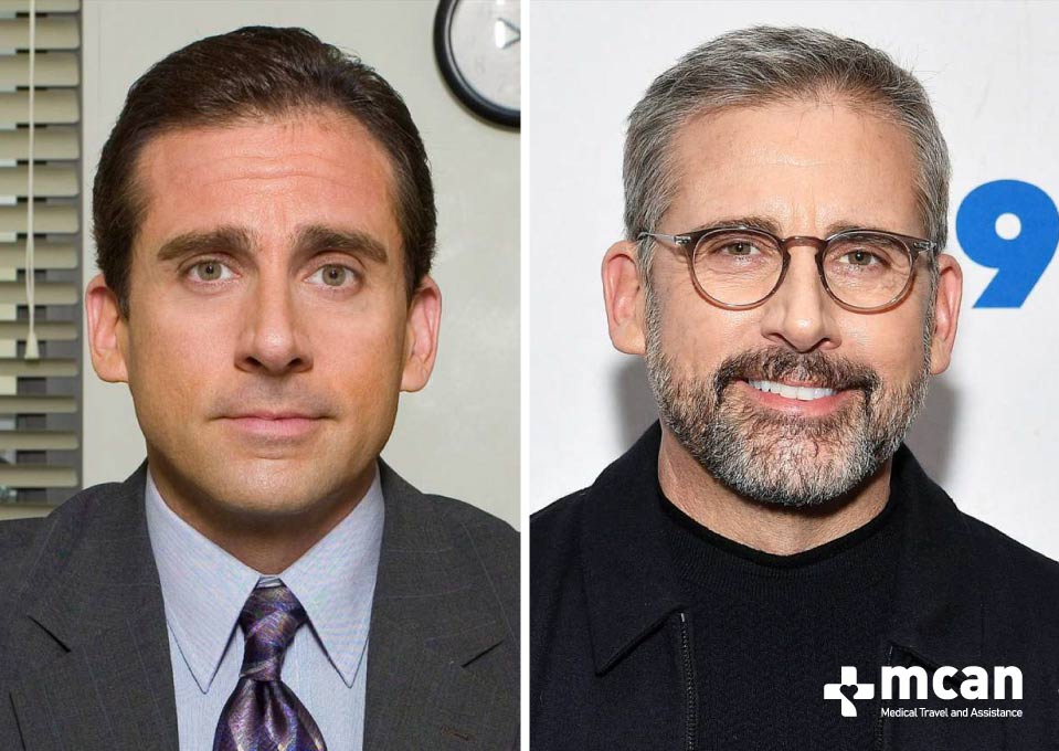 Steve Carell Hair Transplant Before After