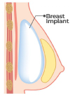 Subglandular Placement