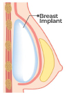 Submuscular Placement