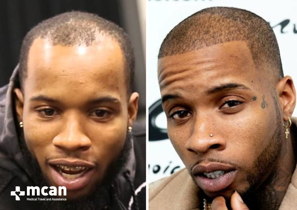 Tory Lanez Hair Transplant Before After