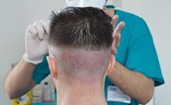 Unshaven Hair Transplant Cover