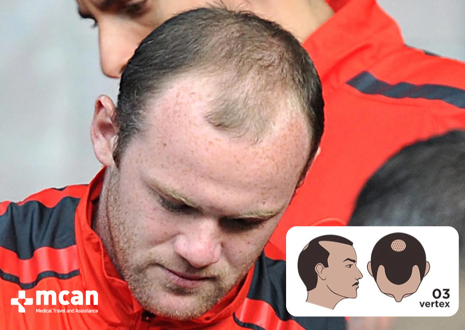 Wayne Rooney Norwood 3 Hair Loss