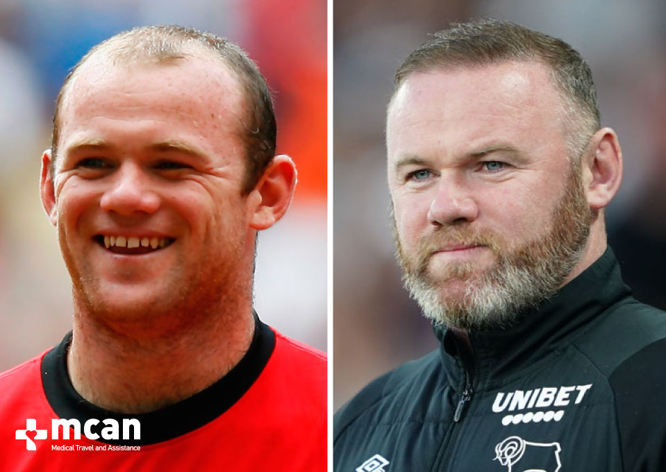 Wayne Rooneys Hair Transplant Before After