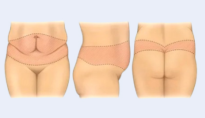 Extended Tummy Tuck