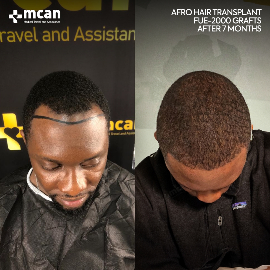 FUE Hair Transplant Before After 1