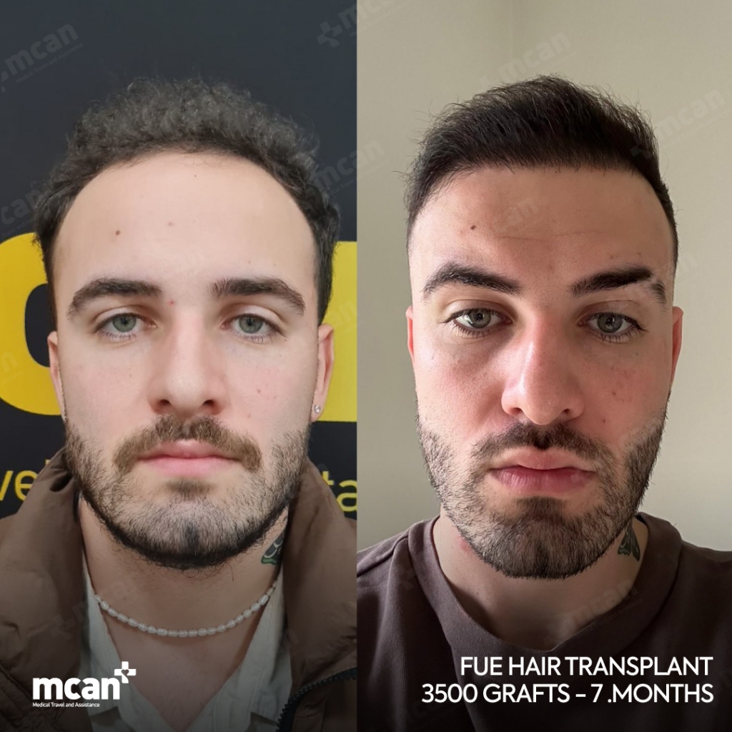 FUE Hair Transplant Before After 10