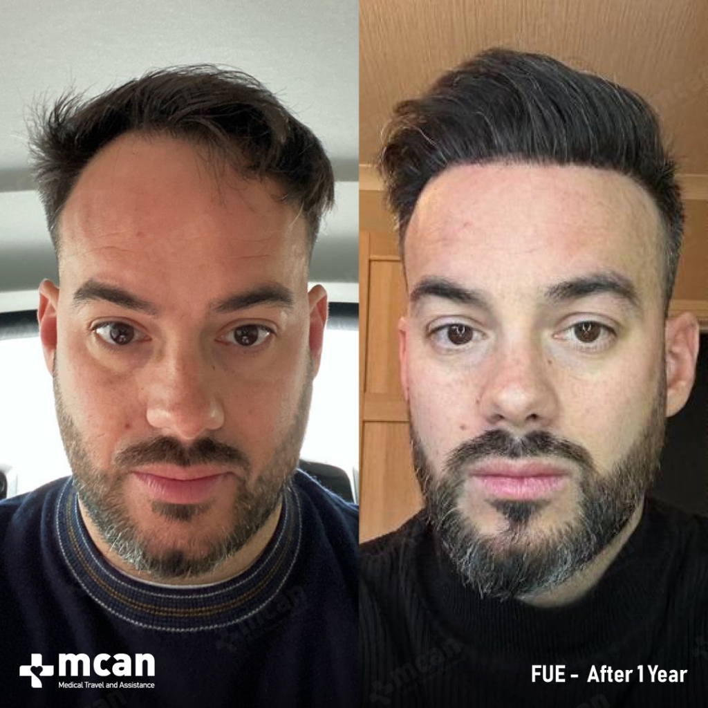 FUE Hair Transplant Before After 11