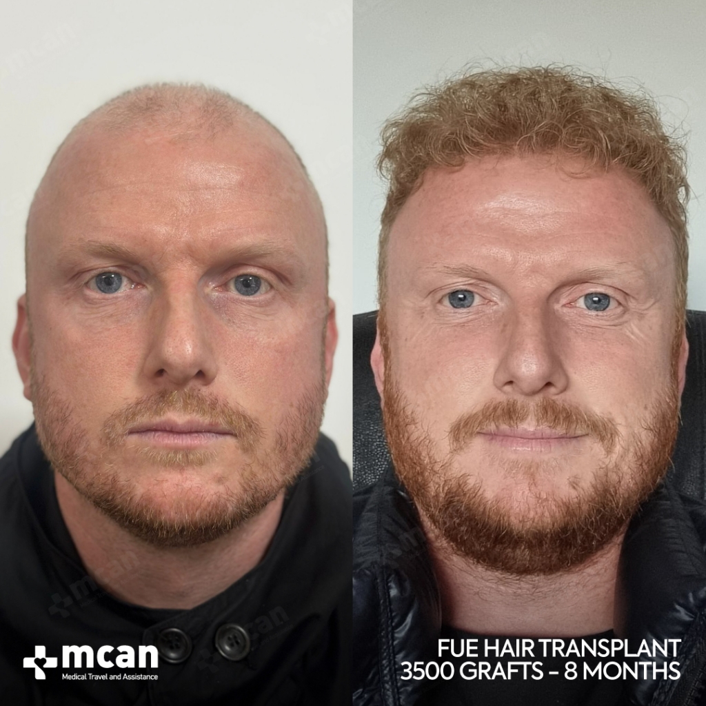 FUE Hair Transplant Before After 2