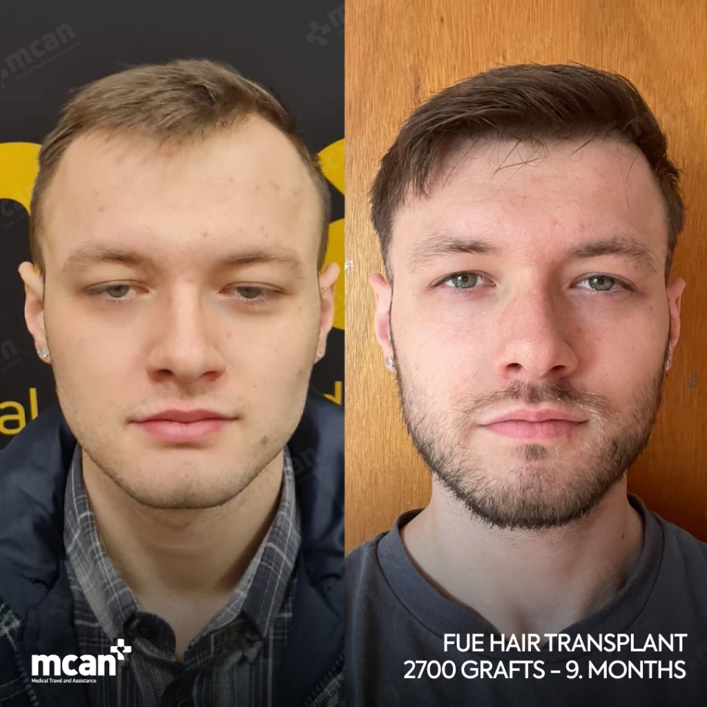 FUE Hair Transplant Before After 3