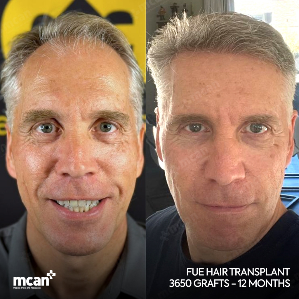 FUE Hair Transplant Before After 5