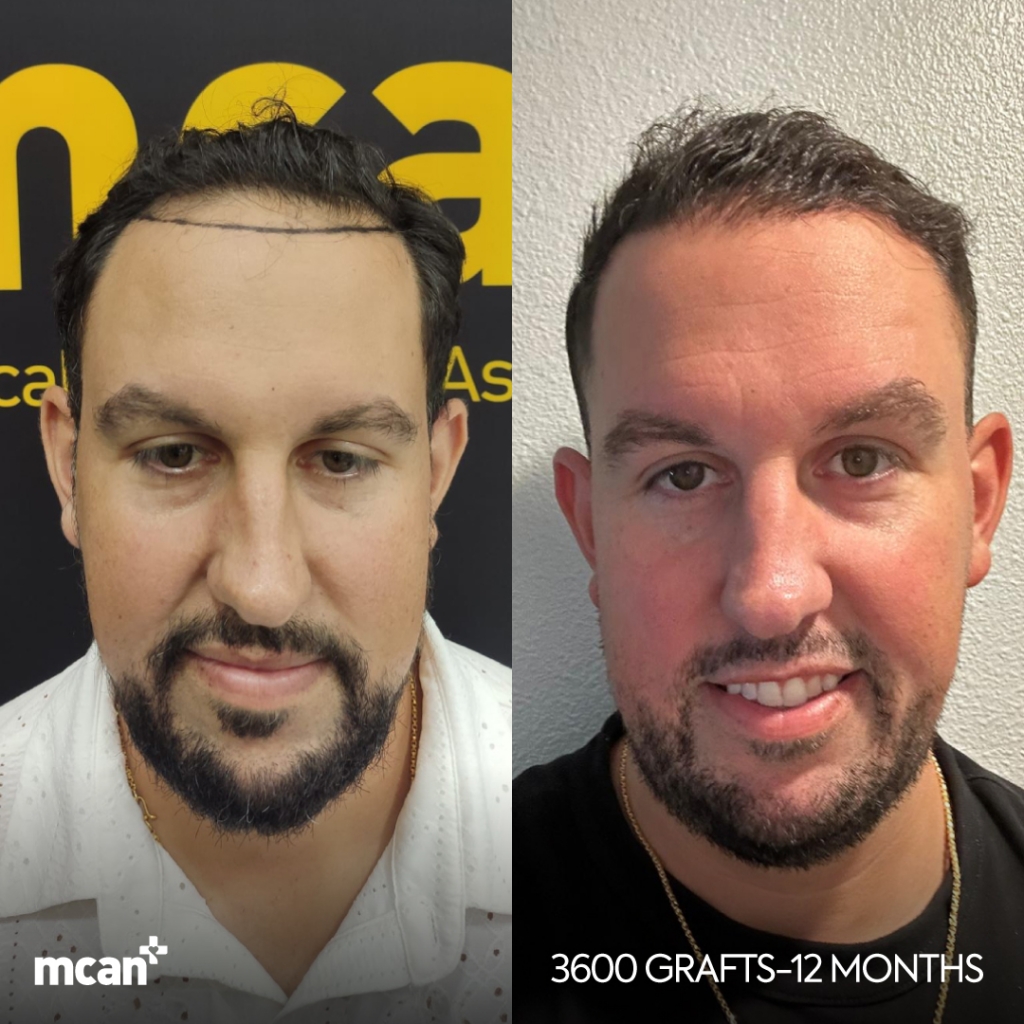 FUE Hair Transplant Before After 6