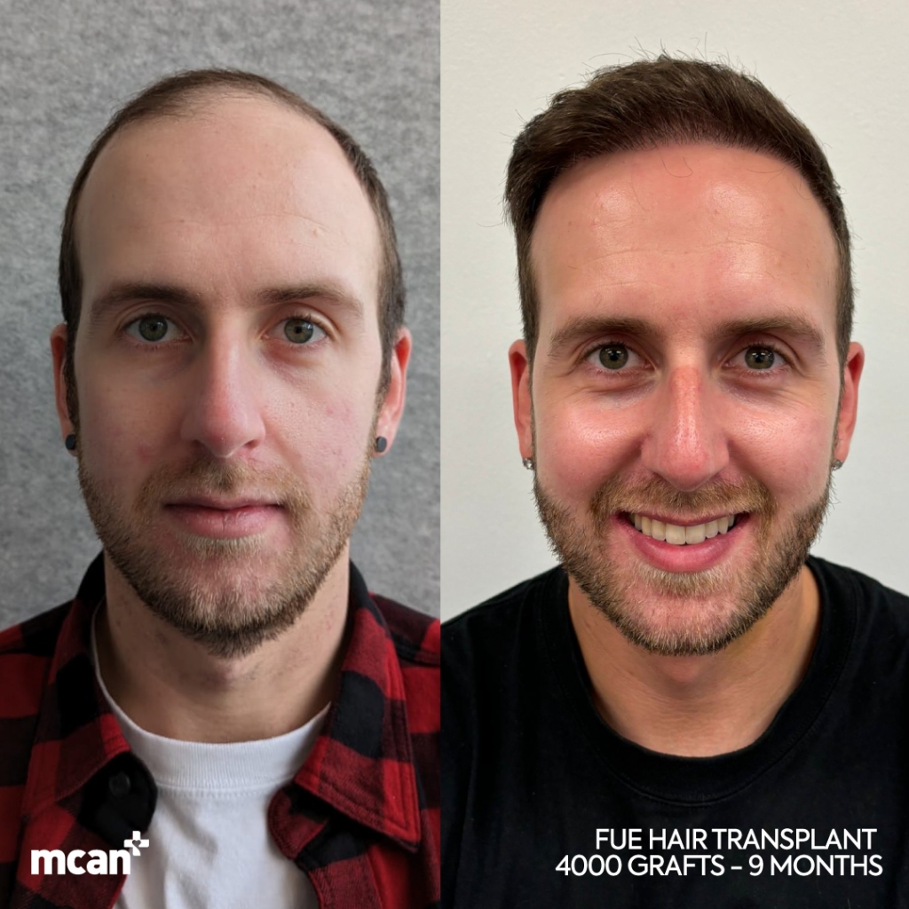 FUE Hair Transplant Before After 7