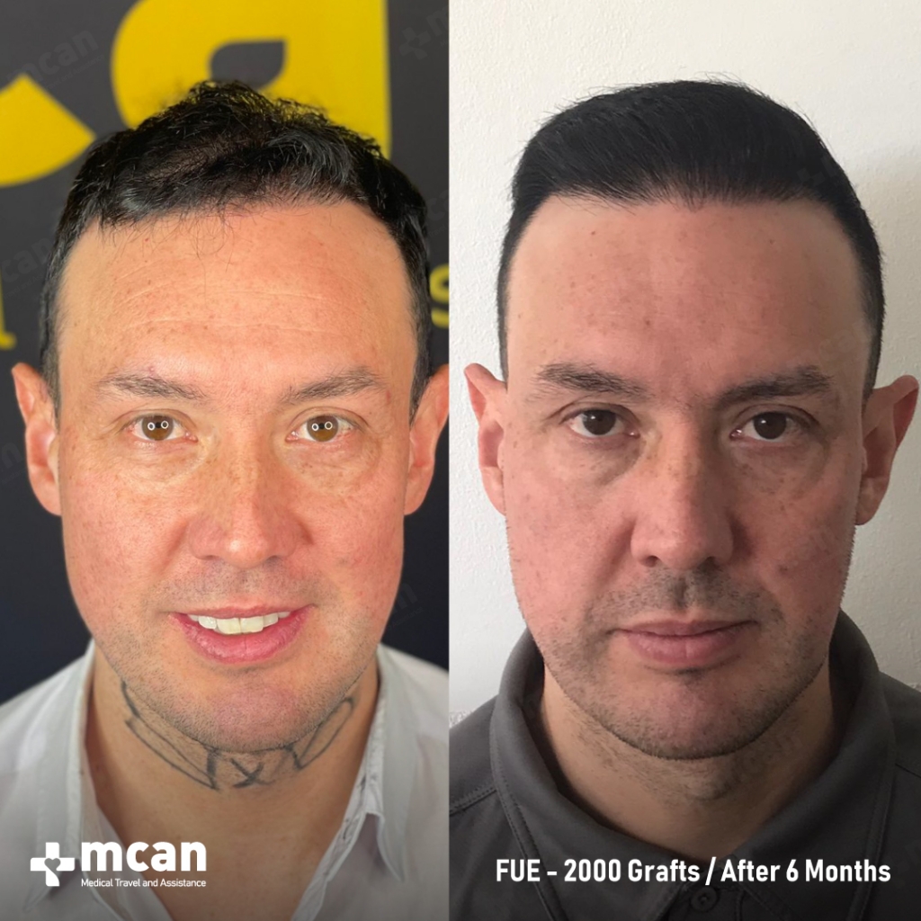 FUE Hair Transplant Before After 9