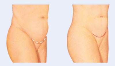 Mini Tummy Tuck