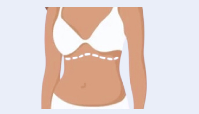 Reverse Tummy Tuck