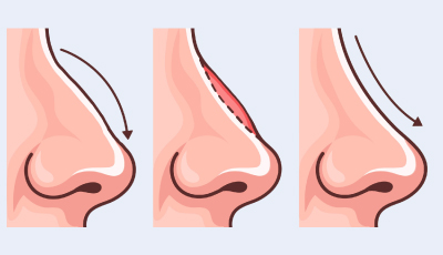 Revision Rhinoplasty