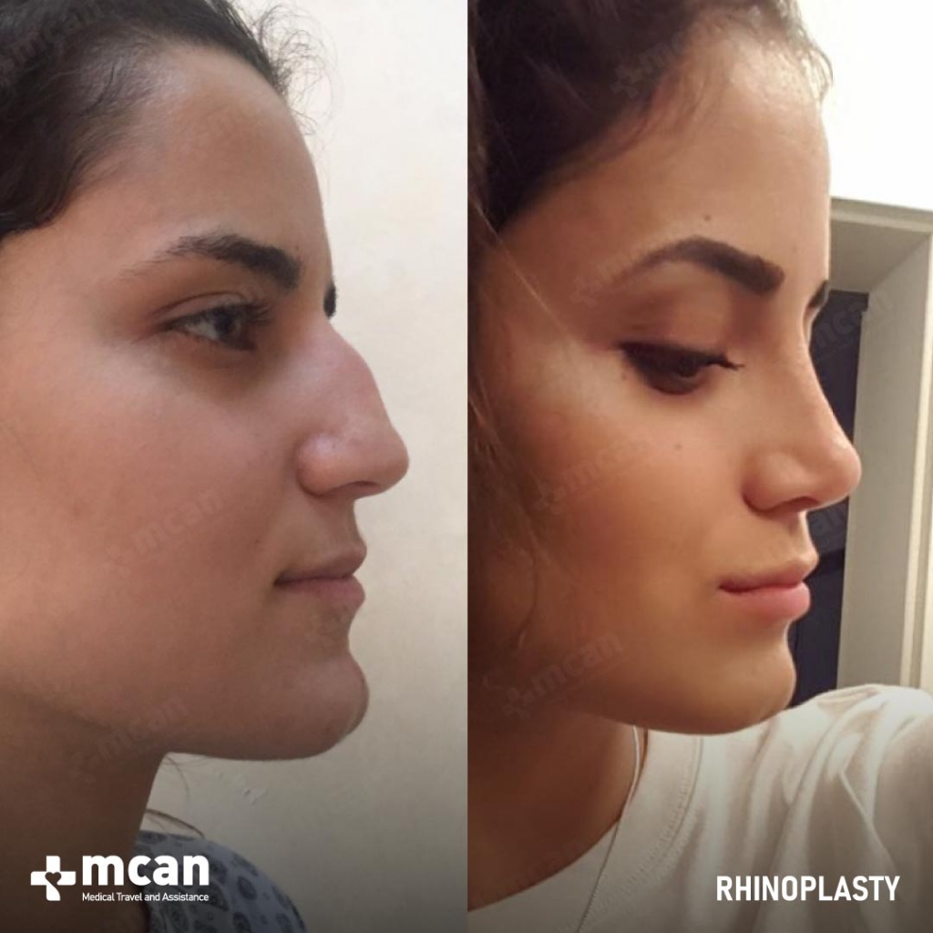 Rhinoplasty Operation Before After Photo 14