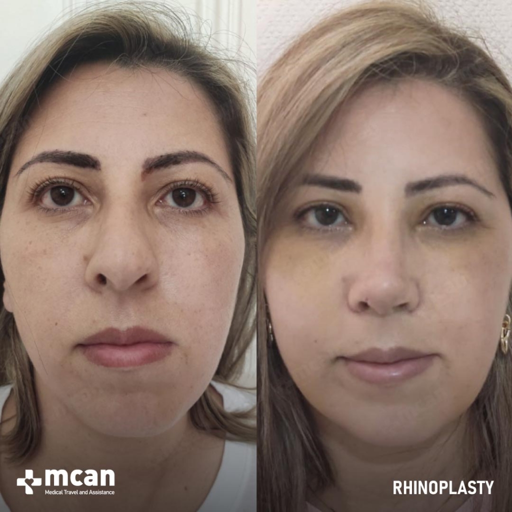 Rhinoplasty Operation Before After Photo 15