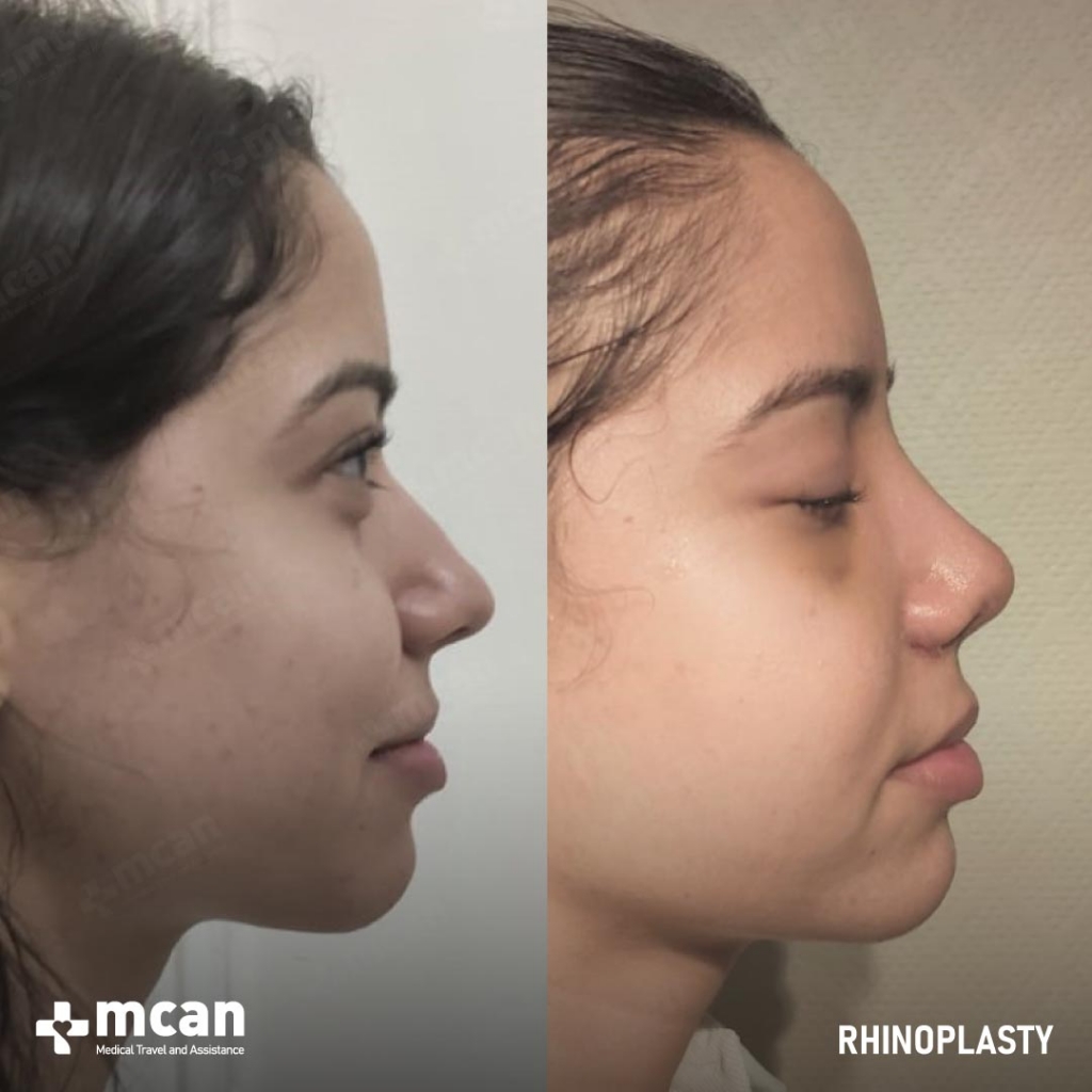 Rhinoplasty Operation Before After Photo 16