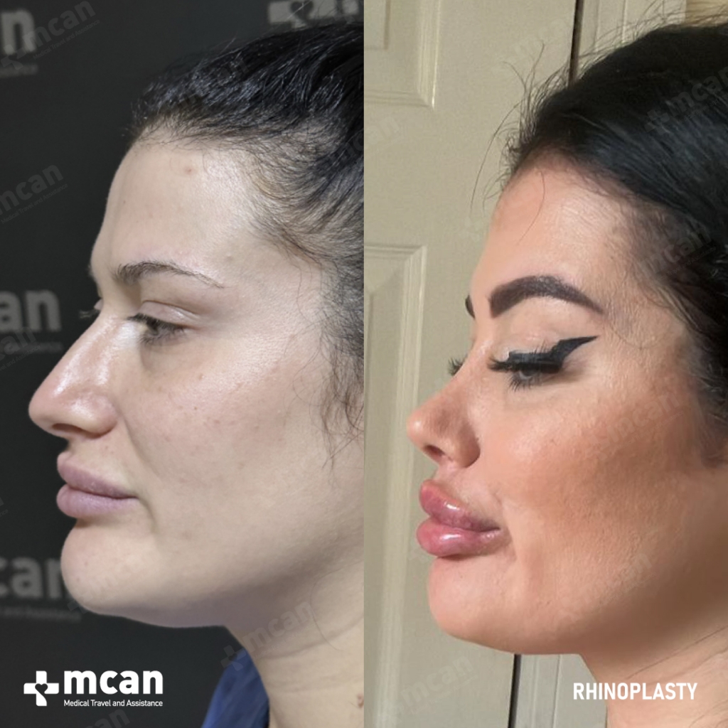 Rhinoplasty Operation Before After Photo 2