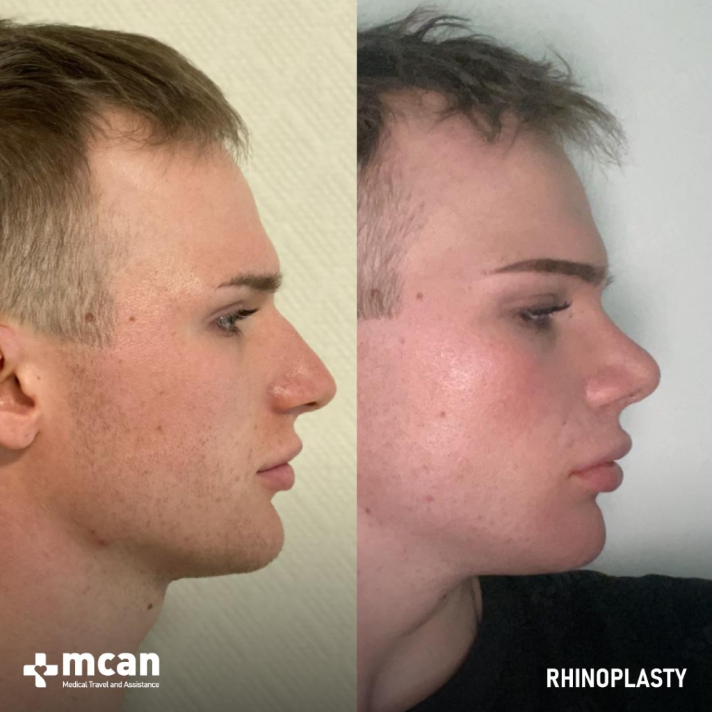 Rhinoplasty Operation Before After Photo 20