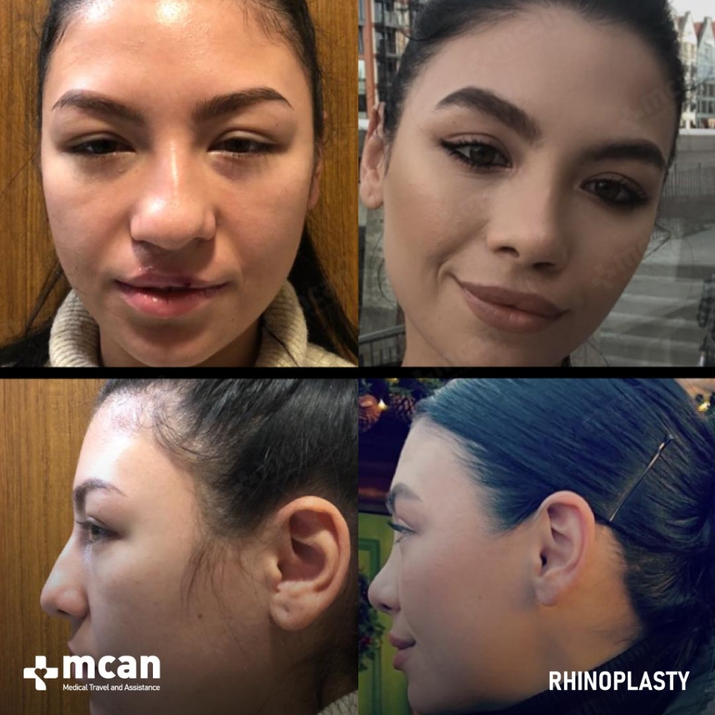 Rhinoplasty Operation Before After Photo 24