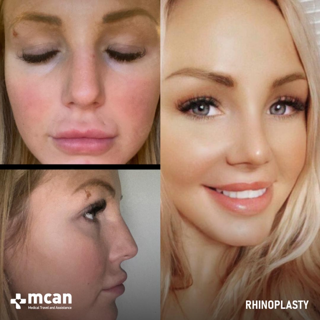 Rhinoplasty Operation Before After Photo 25