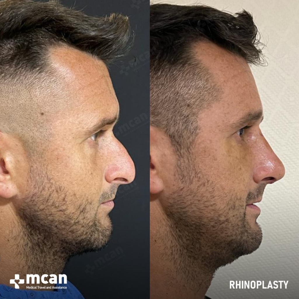 Rhinoplasty Operation Before After Photo 29