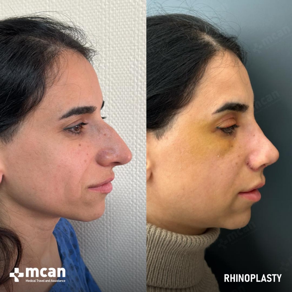 Rhinoplasty Operation Before After Photo 33