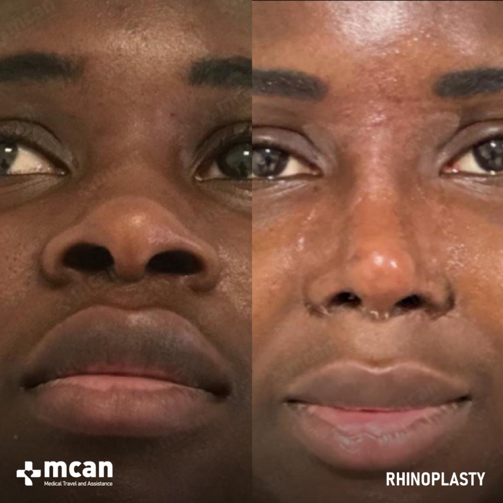 Rhinoplasty Operation Before After Photo 34