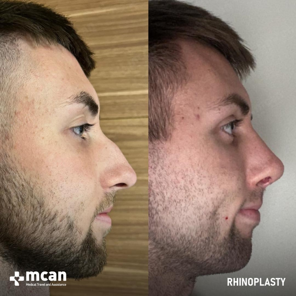 Rhinoplasty Operation Before After Photo 35