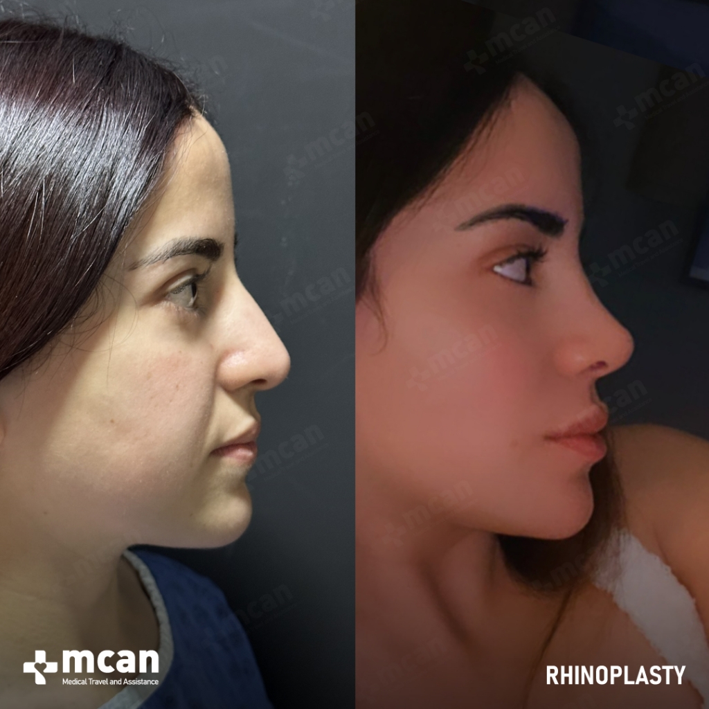 Rhinoplasty Operation Before After Photo 36