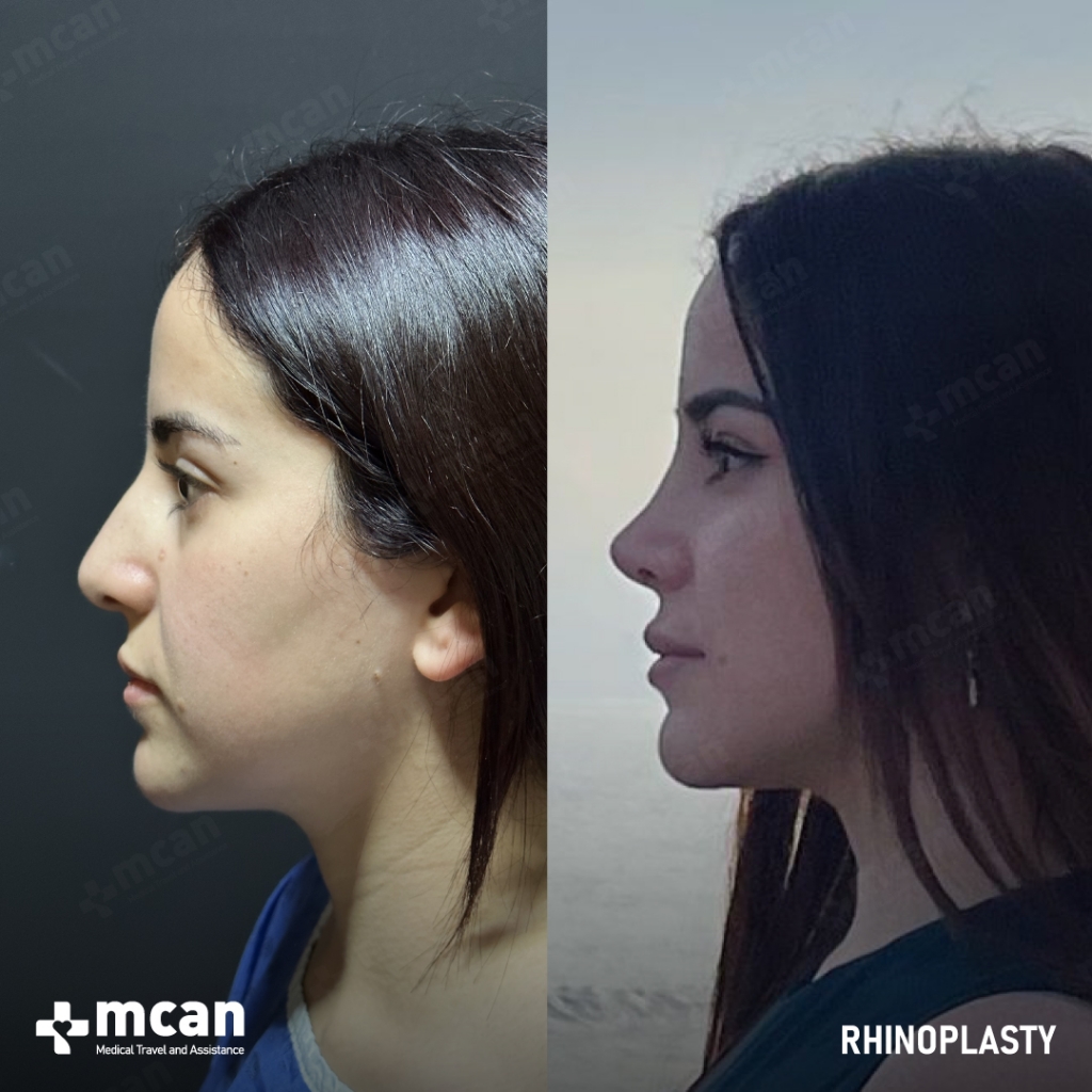 Rhinoplasty Operation Before After Photo 37