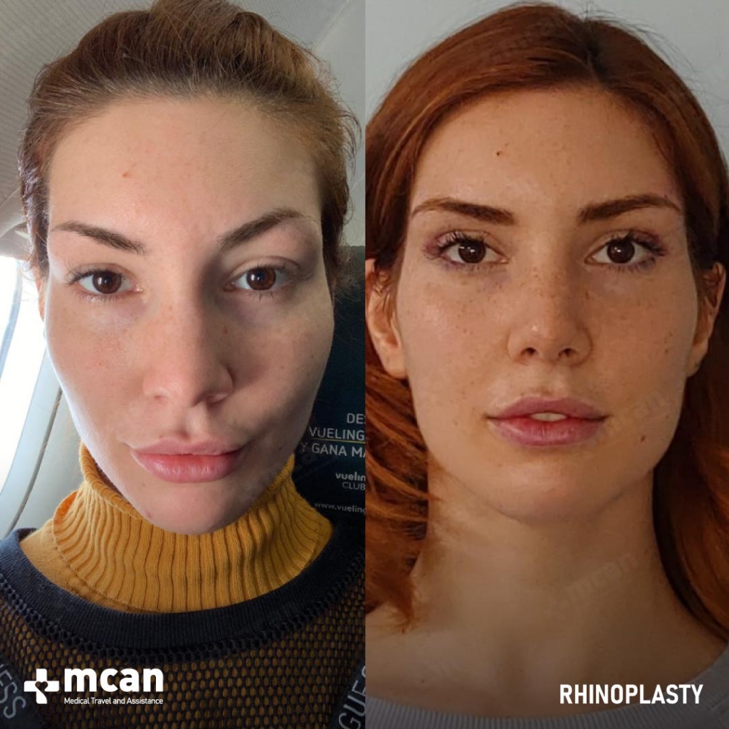 Rhinoplasty Operation Before After Photo 5