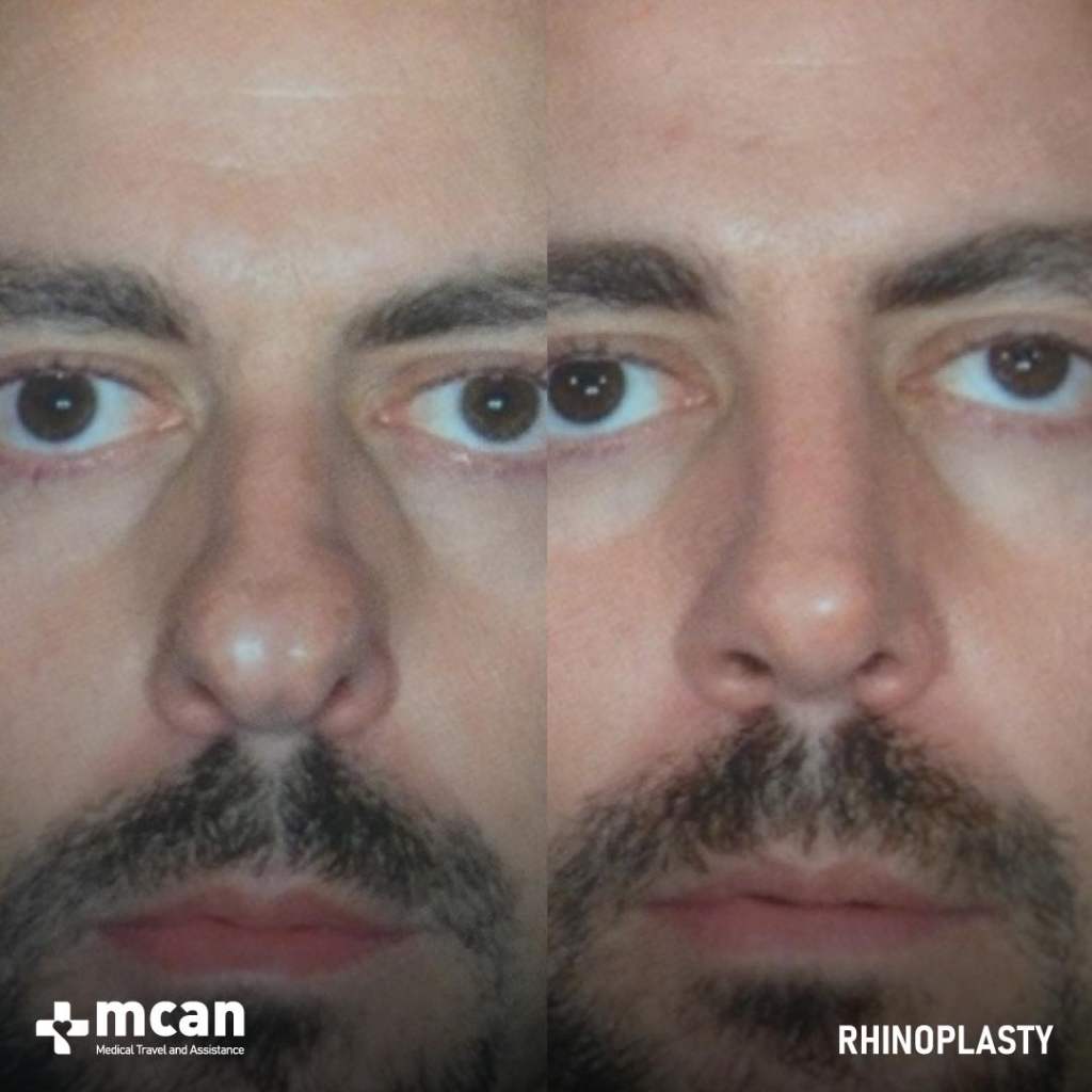 Rhinoplasty Operation Before After Photo 7