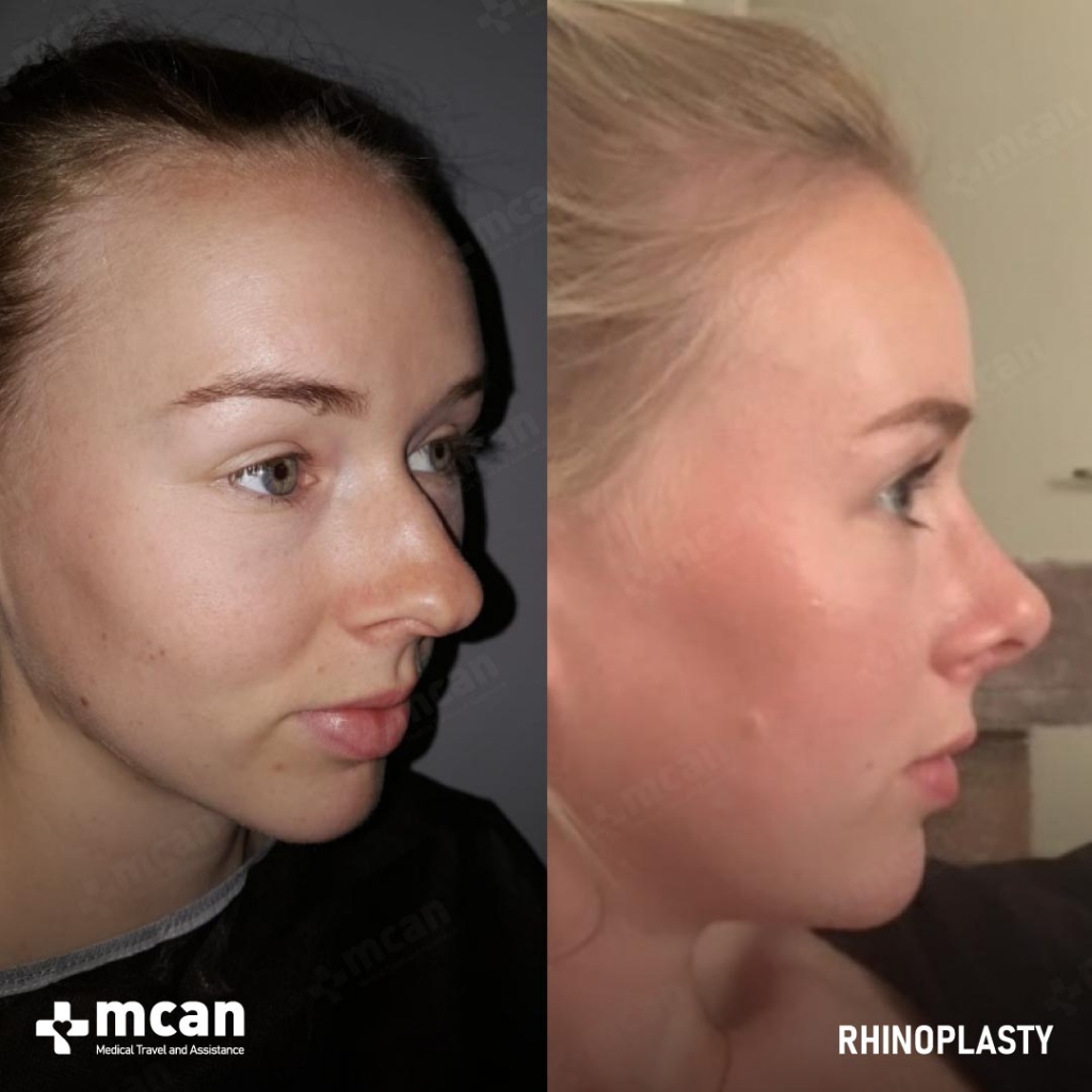 Rhinoplasty Operation Before After Photo 8