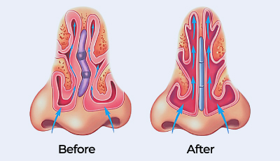 Septorhinoplasty