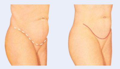 Traditional Tummy Tuck