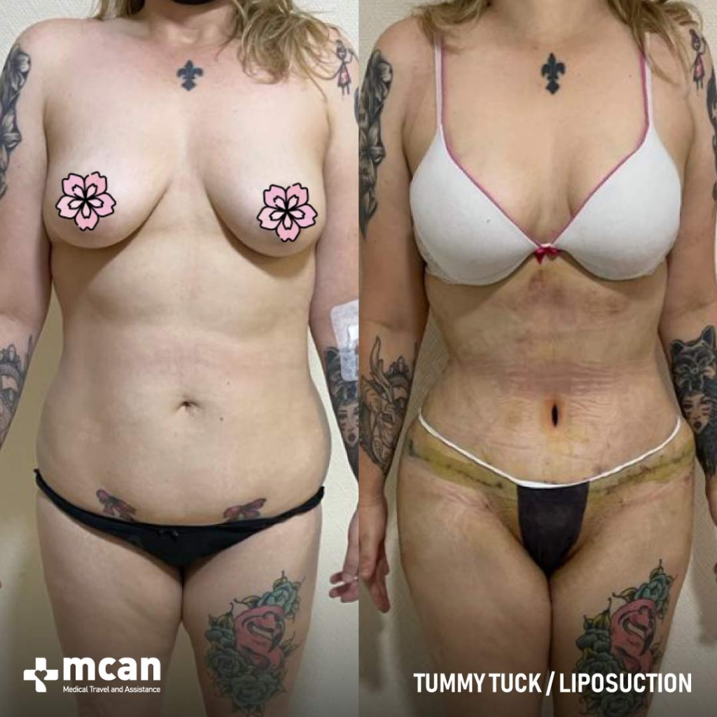 Tummy Tuck Before After 11