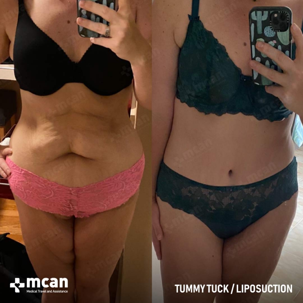 Tummy Tuck Before After 15