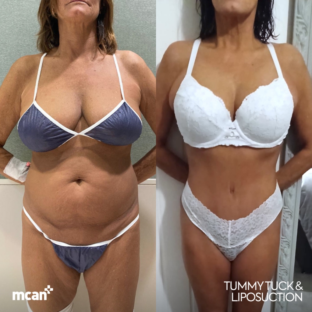 Tummy Tuck Before After 2