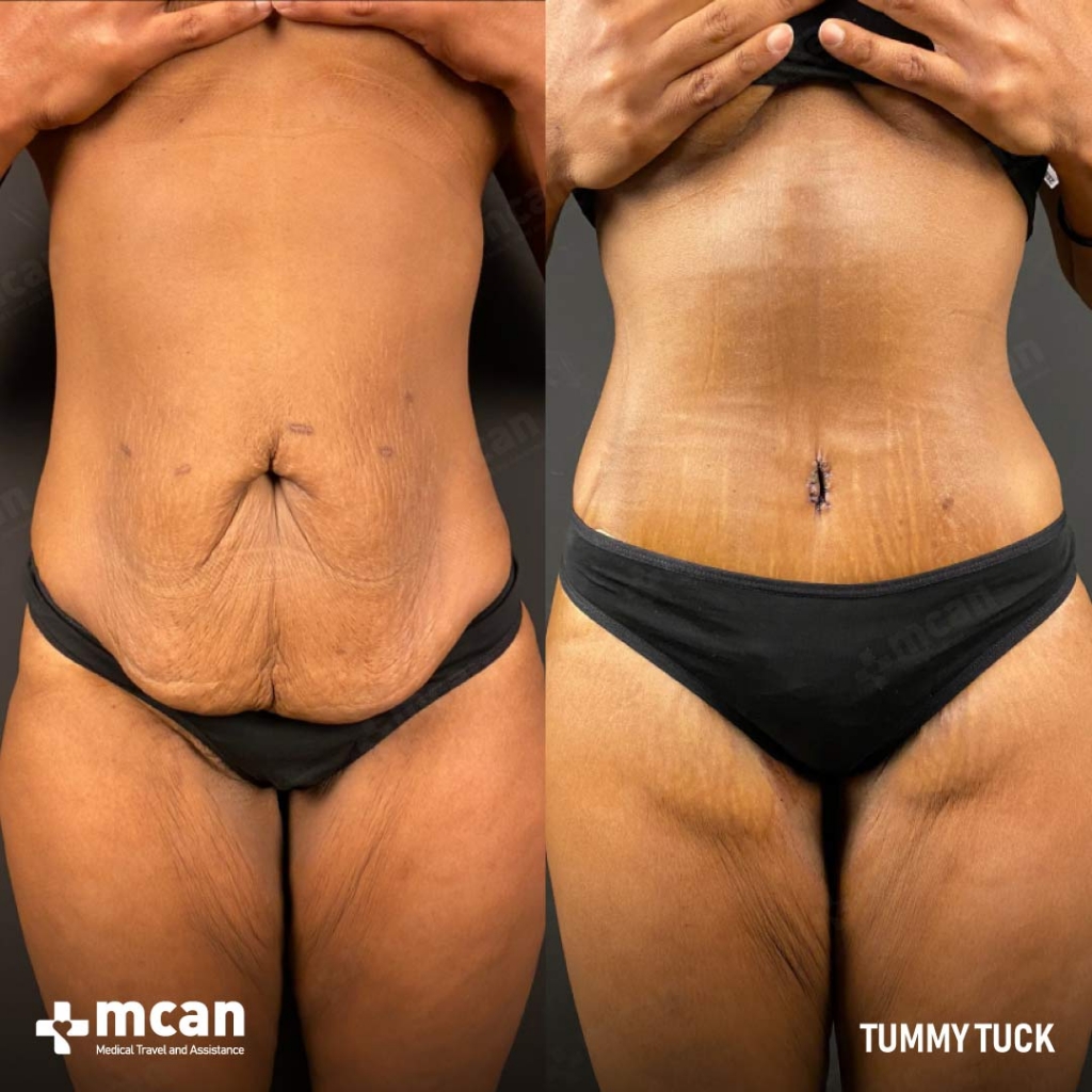 Tummy Tuck Before After 20