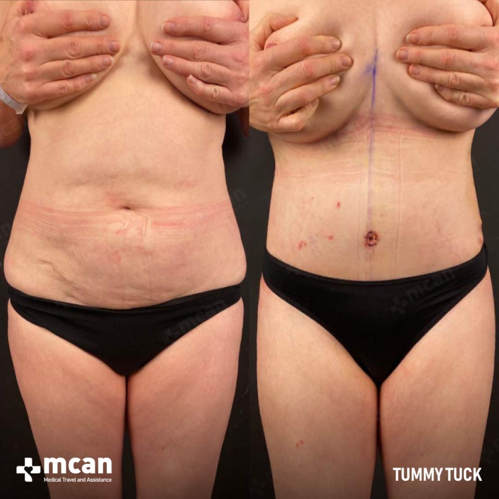 Tummy Tuck Before After 21