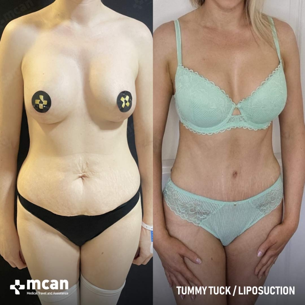 Tummy Tuck Before After 23