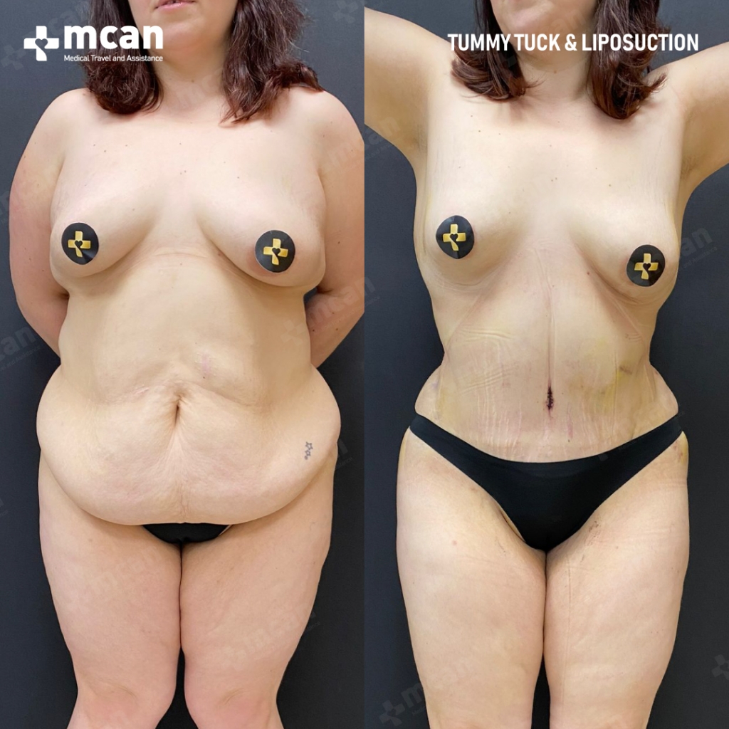 Tummy Tuck Before After 4