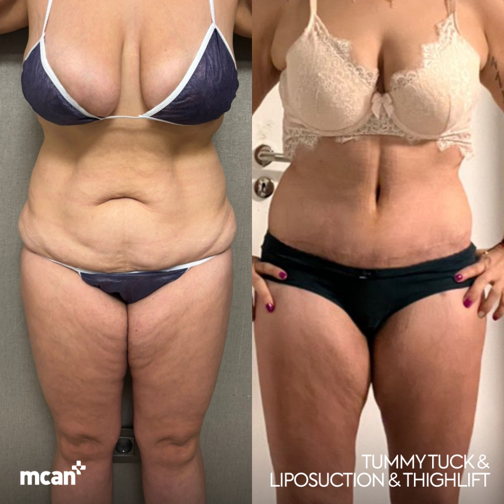 Tummy Tuck Before After 6