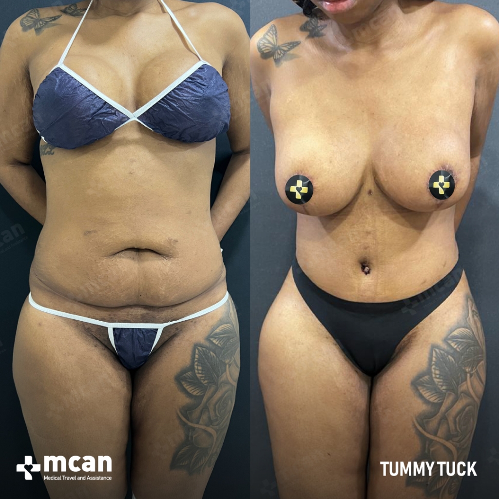 Tummy Tuck Before After 8