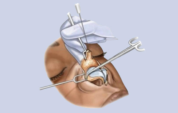 open rhinoplasty