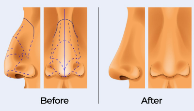 rhinoplasty